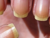إليكم أسباب اصفرار الأظافر؟